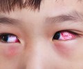 Đau mắt đỏ có phải là triệu chứng của COVID19 
