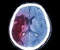 4 dấu hiệu trước khi khởi phát bệnh xuất huyết não nhưng dễ bị bỏ qua 