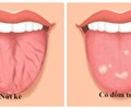 Nếu lưỡi có đốm trắng rất có thể bạn đã mắc phải một trong số các bệnh nghiêm trọng 