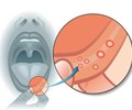 Nếu có 3 dấu hiệu này ở miệng thì đó có thể là dấu hiệu cho thấy bệnh ung thư sắp đến 