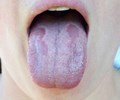 Khi lưỡi xuất hiện những đặc điểm này cần đi khám ngay có dấu hiệu đặc biệt có thể là bệnh ung thư  