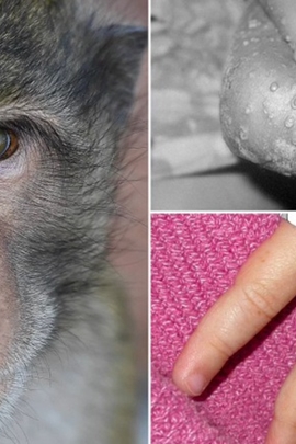 6 biện pháp phòng chống dịch bệnh đậu mùa khỉ mà bạn cần biết