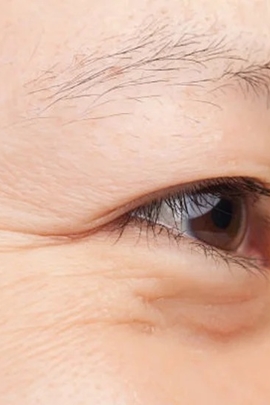 5 nguyên nhân khiến mắt của người trẻ vẫn có nếp nhăn
