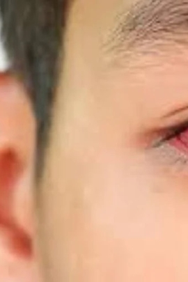 Chữa đau mắt đỏ bằng lá trầu không có hiệu quả không? Bác sĩ đưa ra lời khuyên để bệnh nhanh khỏi