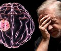 6 dấu hiệu cực bình thường cảnh báo khối u não rất ít người biết đến 